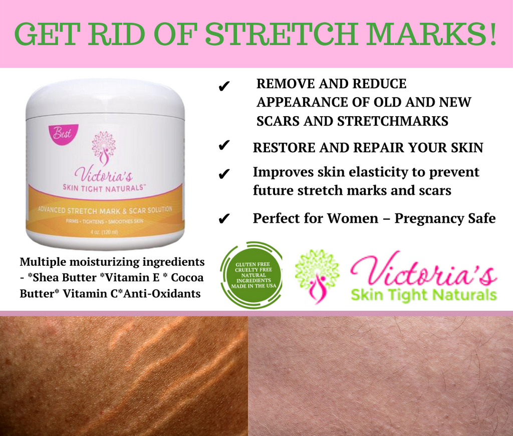cream to get rid of stretch marks fast