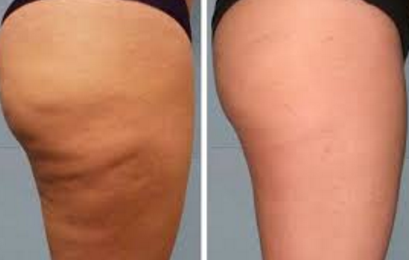 thighs dimply slims tones best cellulite detoxing fat burning cream